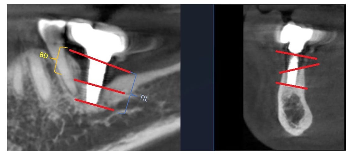 CBCT assessment of peri-implant bone loss showing bone defect depth and total implant length