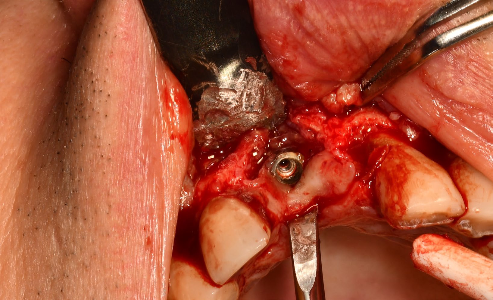 Intraoperative view after flap elevation around an implant affected by advanced peri-implantitis