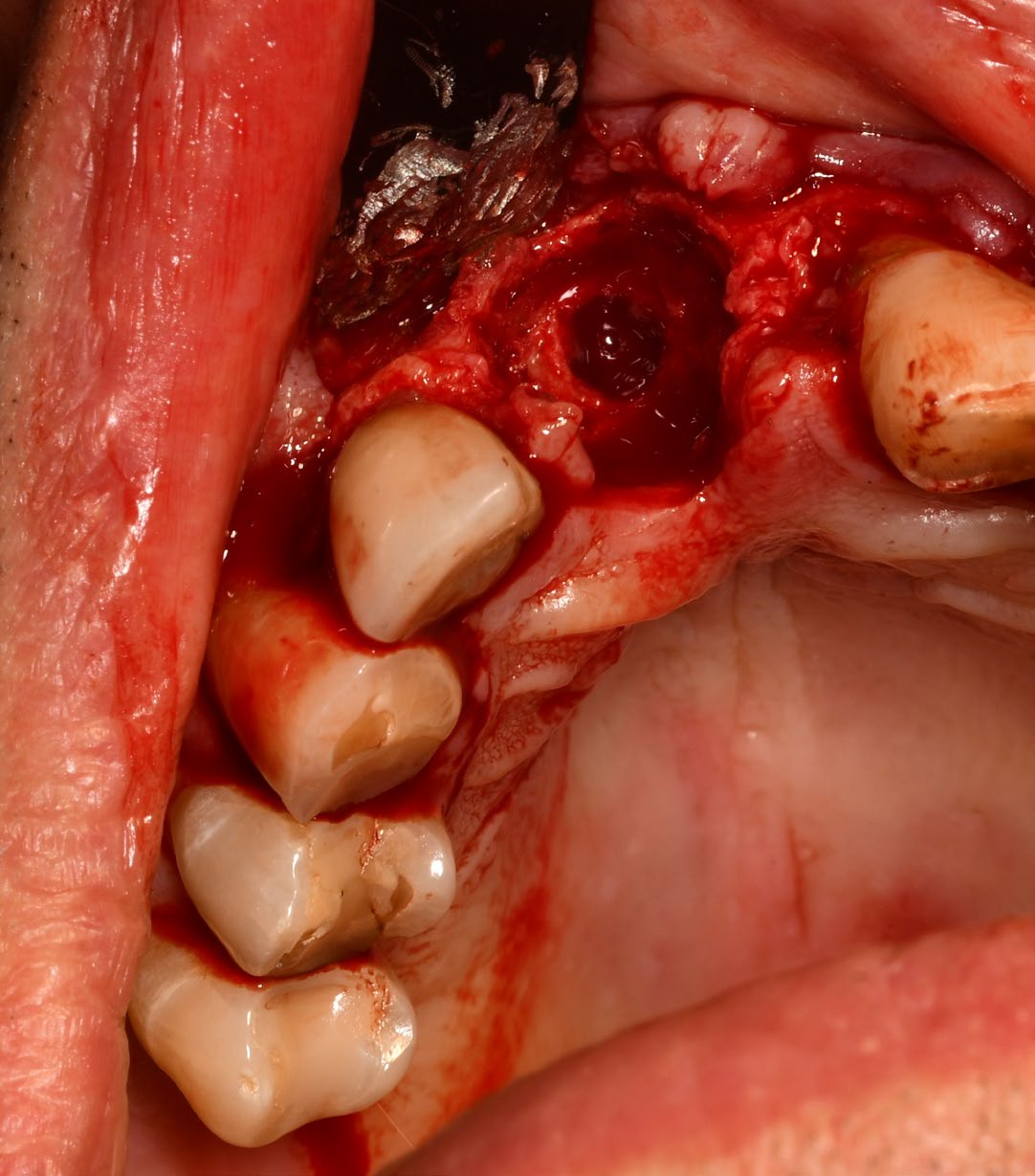 Peri-implant defect after implant removal and curettage
