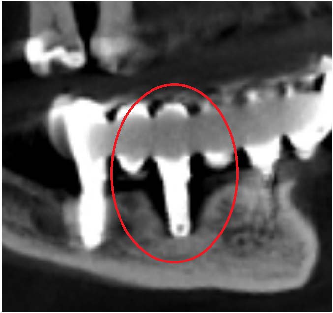 Advanced bone loss around the implant in region 34