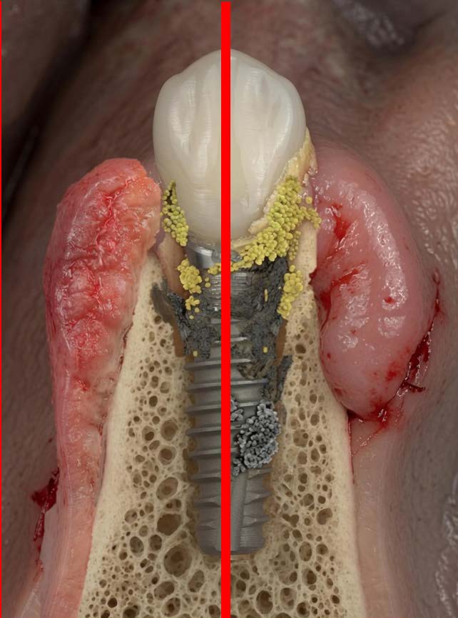Extensive inflammatory lesions surrounding the implant