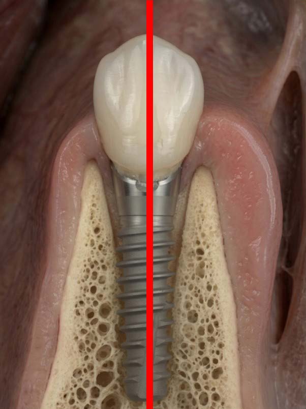 Healthy tissues surrounding the implant
