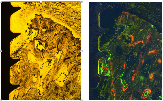 Histological views of peri-implantitis